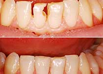 Восстановление зубов и рестайлинг улыбки